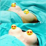 SAmple breast implants