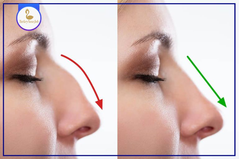 Cartilage Graft Nose Jobs Here’s All You Need to Know Turkeynosejob