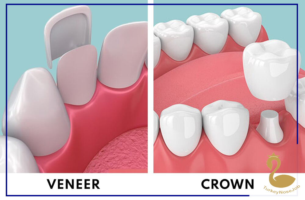 DENTAL VENEERS VS LAMINATES WHAT IS THE DIFFERENCE Turkeynosejob
