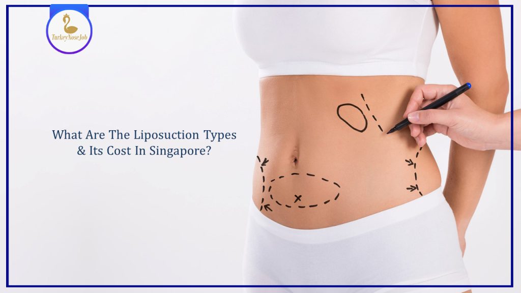 How much does liposuction cost? Tips affecting the price