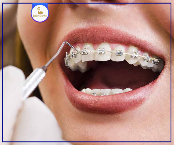 REINVENT YOUR SMILE WITH SPEED BRACES Turkeynosejob Plastic surgery